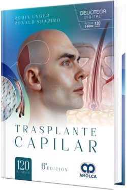 TRASPLANTE CAPILAR