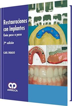 RESTAURACIONES CON IMPLANTES GUIA PASO A PASO